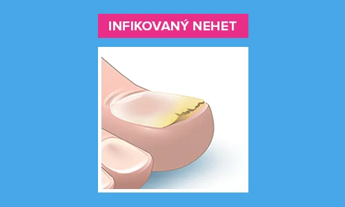 Infikovaný nehet