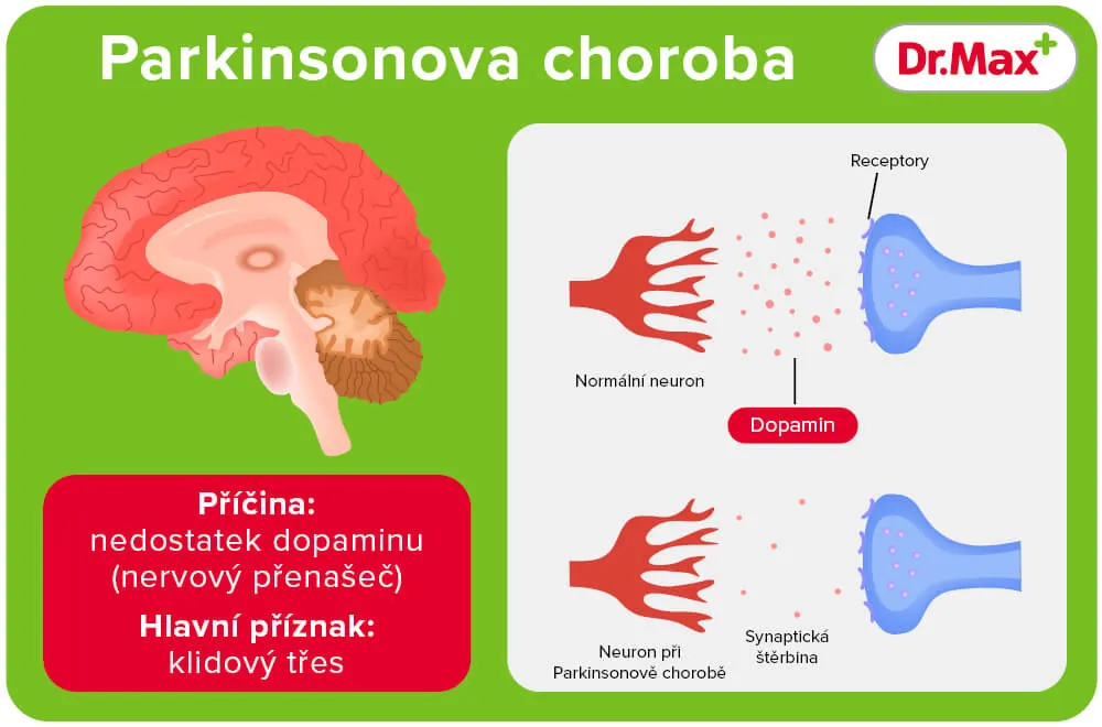 Parkinsonova choroba a nedostatek dopaminu