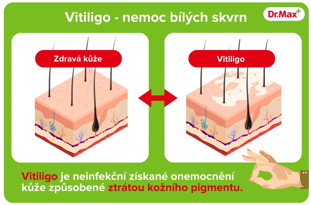 Vitiligo neboli nemoc bílých skvrn versus zdravá kůže