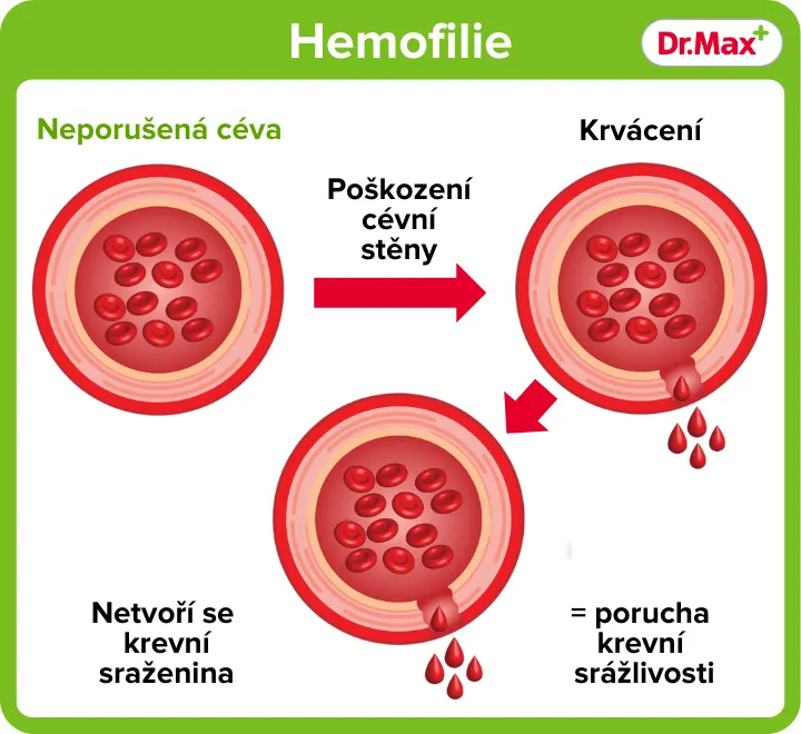 Jak se projevuje porucha srážlivosti krve?