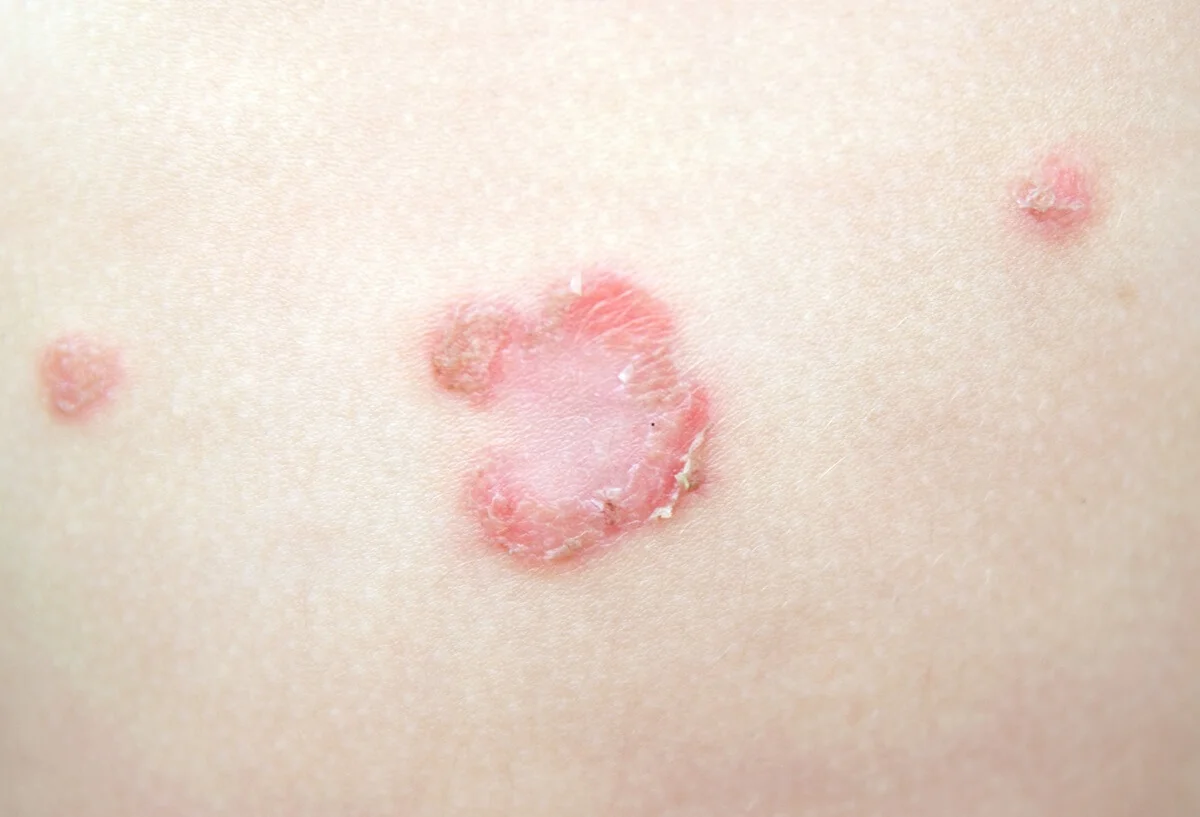 Impetigo často postihuje děti v mladším školním věku.